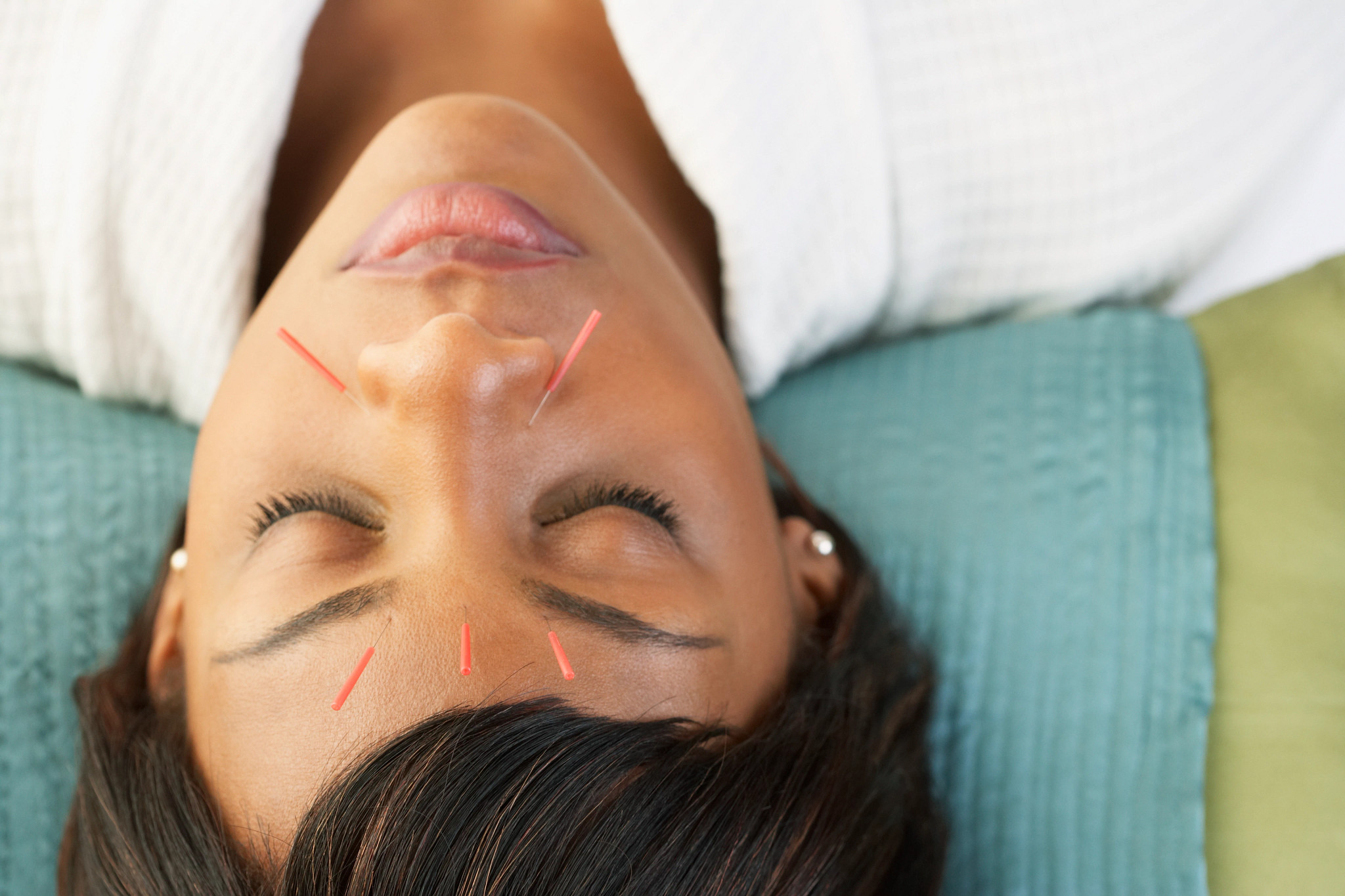 Woman with brown hair with acupuncture needles.